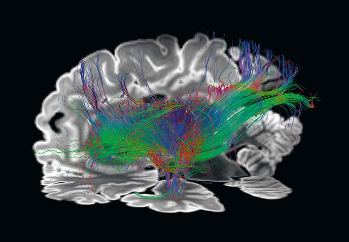 Picture of a brain affected by traumatic brain injury